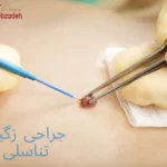 درمان زگیل تناسلی با جراحی