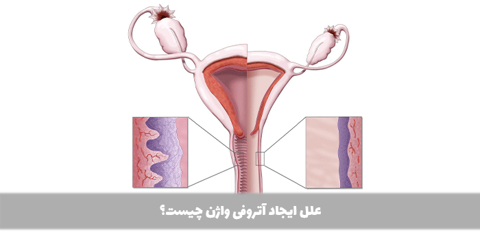 علل ایجاد آتروفی واژن