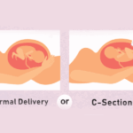 زایمان طبیعی بهتره یا سزارین