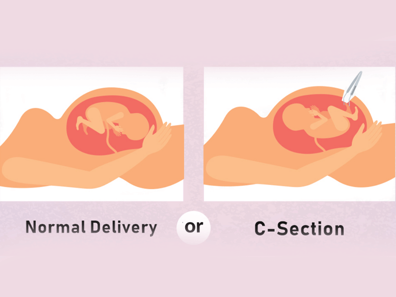زایمان طبیعی بهتره یا سزارین
