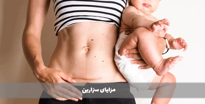 مزایای سزارین
