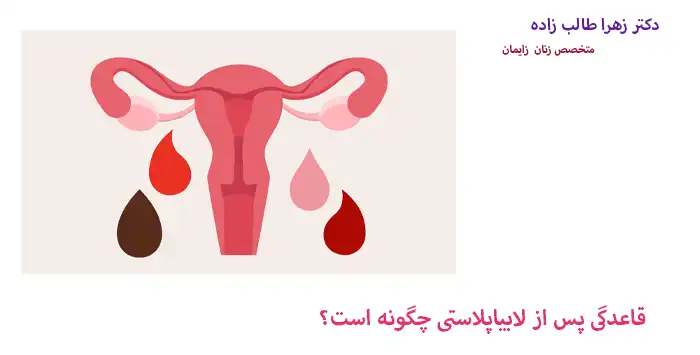 قاعدگی پس از لابیاپلاستی چگونه است؟