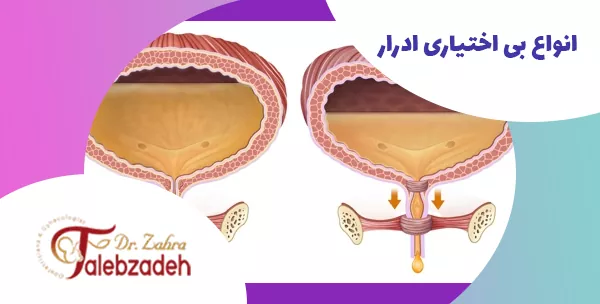 انواع بی اختیاری ادرار