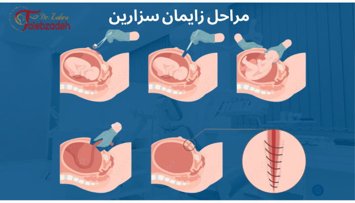 مراحل زایمان سزارین